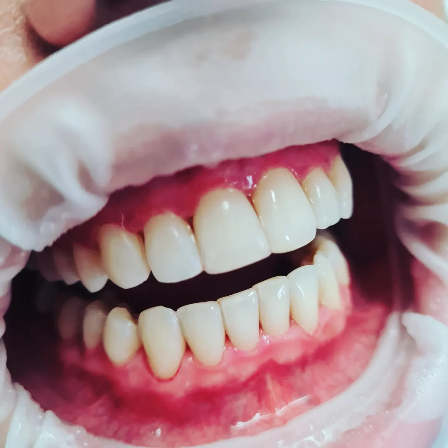 Immagine clinica pubblicata dallo studio: Mascherine trasparenti e sbiancamento
